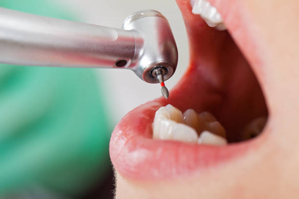 Emergency Dental Filling Replacement in IL